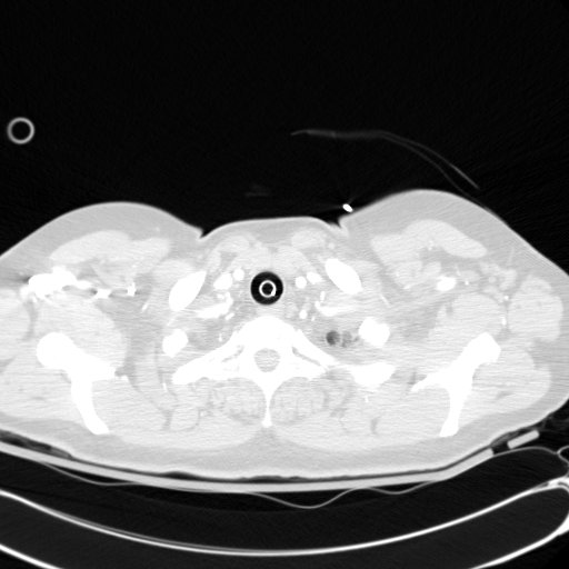 Acute myocardial infarction in CT (Radiopaedia 39947-42415 Axial lung window 5).jpg