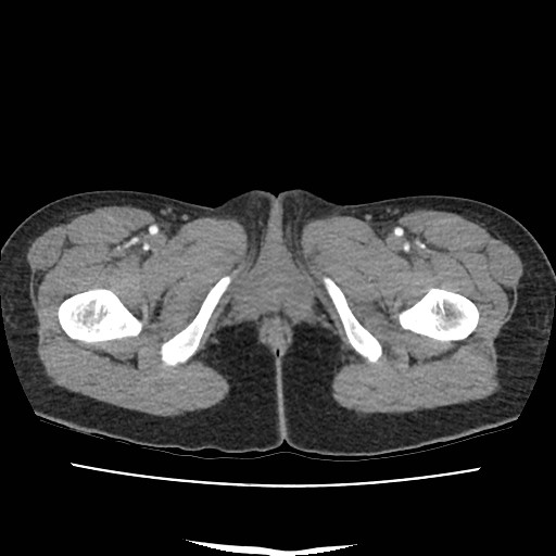 File:Acute myocarditis (Radiopaedia 55988-62613 Axial C+ portal venous phase 88).jpg