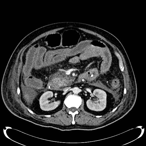 Acute pancreatic necrosis (Radiopaedia 13560-18500 Axial C+ portal venous phase 66).jpg