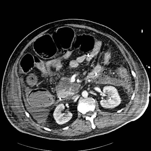 Acute pancreatic necrosis (Radiopaedia 13560-18502 Axial C+ portal venous phase 38).jpg