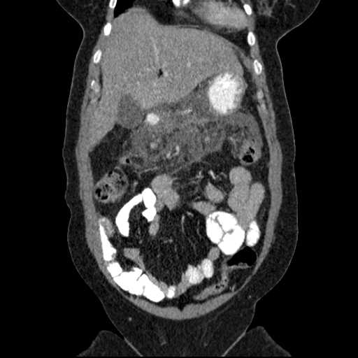 File:Acute pancreatitis (Radiopaedia 20829-20744 Coronal C+ portal venous phase 16).jpg