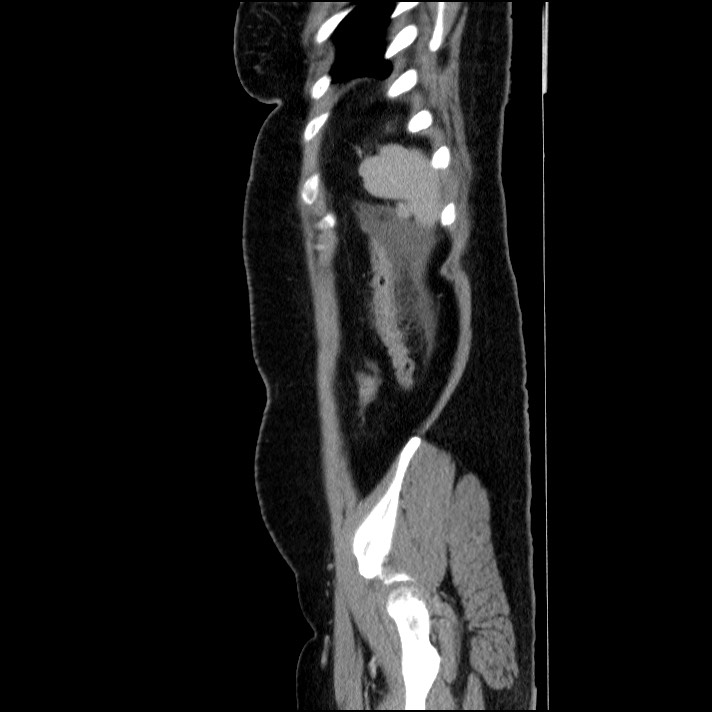 Acute pancreatitis (Radiopaedia 69236-79012 Sagittal C+ portal venous phase 23).jpg