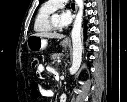 File:Acute pancreatitis (Radiopaedia 85146-100701 Sagittal C+ portal venous phase 55).jpg