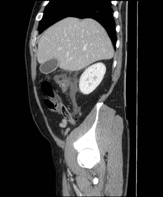 Acute pancreatitis - Balthazar E (Radiopaedia 23080-23110 Sagittal C+ portal venous phase 19).jpg