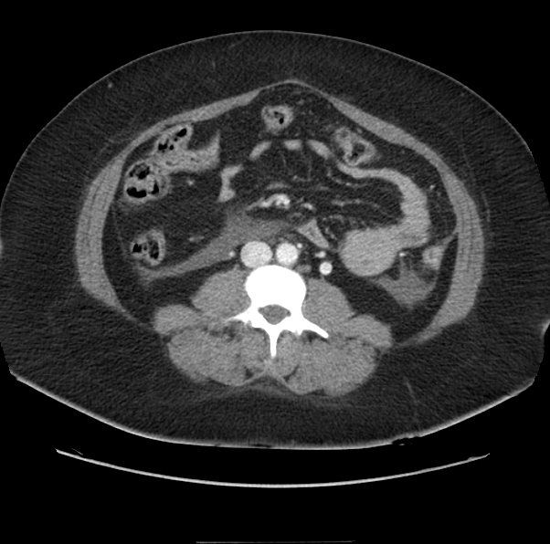 Acute pancreatitis - Balthazar E (Radiopaedia 29016-29377 Axial C+ portal venous phase 39).png