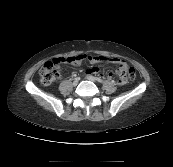 Acute pancreatitis - Balthazar E - post ERCP (Radiopaedia 27562-27772 Axial C+ portal venous phase 50).png