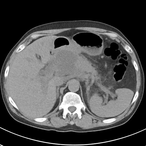 File:Acute pancreatitis and walled-off necrosis (Radiopaedia 29888-30404 Axial non-contrast 19).jpg