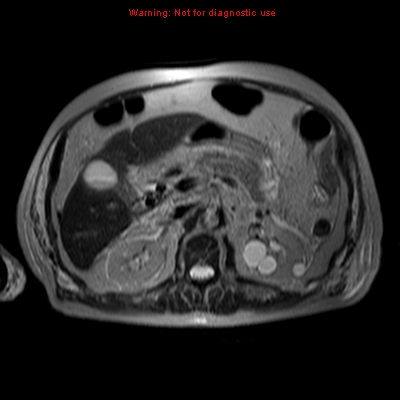 File:Acute pancreatitis with incidental pancreatic lipoma (Radiopaedia 10190-10732 Axial T2 10).jpg