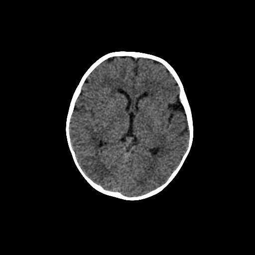 Acute phase of hemiconvulsion-hemiplegia epilepsy syndrome (Radiopaedia 29309-29744 Axial non-contrast 27).jpg