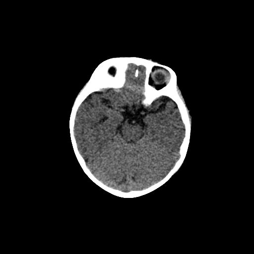 Acute phase of hemiconvulsion-hemiplegia epilepsy syndrome (Radiopaedia 29309-29744 Axial non-contrast 35).jpg