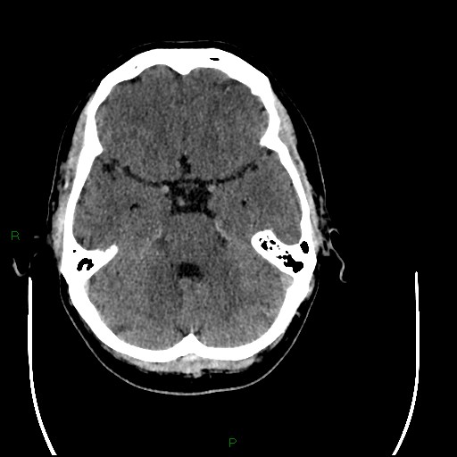 File:Acute posterior cerebral artery territory infarct (Radiopaedia 79329-92393 Axial non-contrast 34).jpg