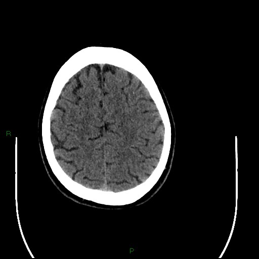 Acute posterior cerebral artery territory infarct (Radiopaedia 79329-92393 Axial non-contrast 87).jpg