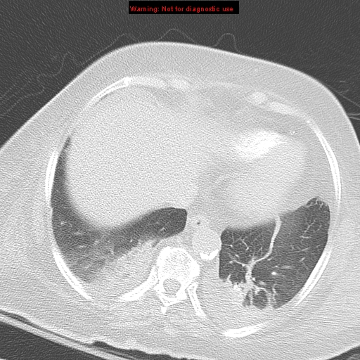 File:Acute pulmonary embolism (Radiopaedia 13286-13289 B 32).jpg