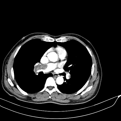 Acute pulmonary embolism (Radiopaedia 69510-79390 D 17).jpg