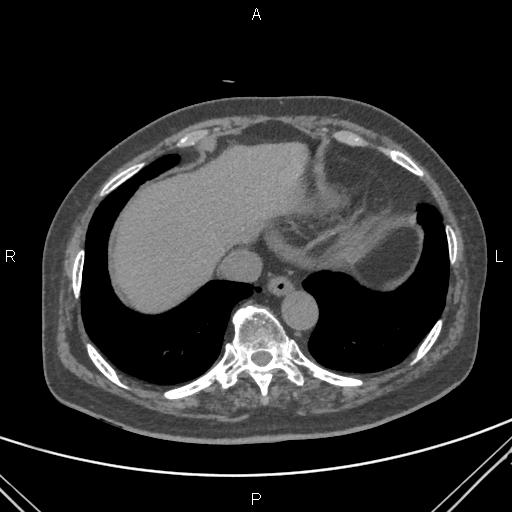 Acute renal artery occlusion (Radiopaedia 86586-102682 Axial non-contrast 4).jpg