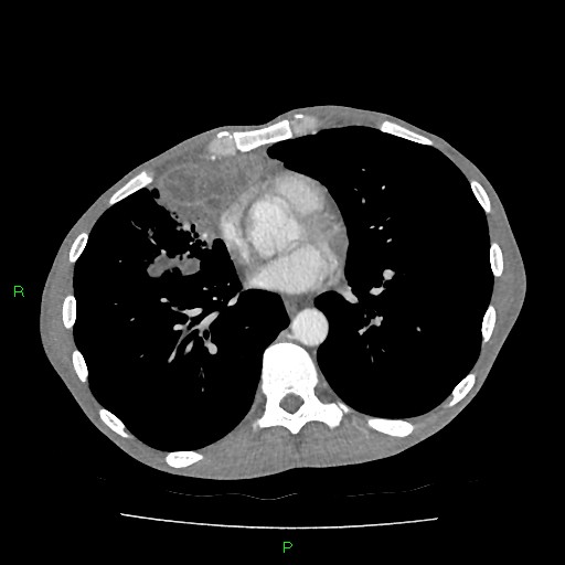 File:Acute right lung abscess (Radiopaedia 34806-36258 Axial C+ arterial phase 115).jpg