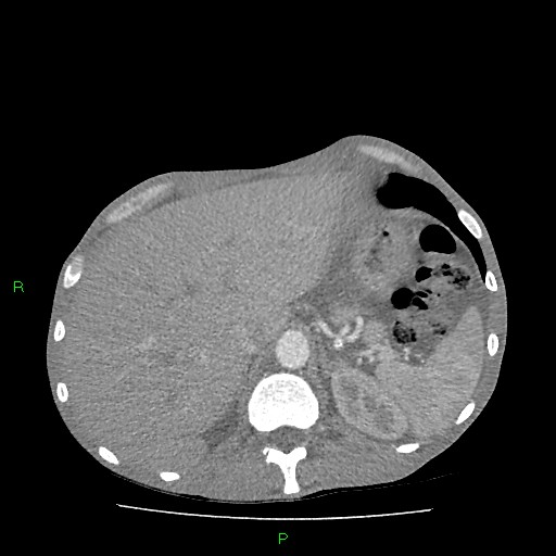 File:Acute right lung abscess (Radiopaedia 34806-36258 Axial C+ arterial phase 180).jpg