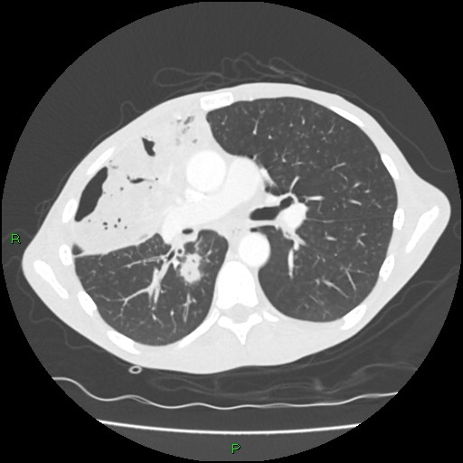 Acute right lung abscess (Radiopaedia 34806-36258 Axial lung window 87).jpg