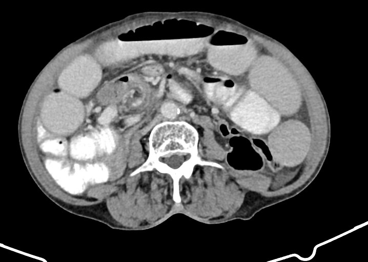 Acute small bowel (ileal) volvulus (Radiopaedia 71740-82139 Axial C+ portal venous phase 113).jpg