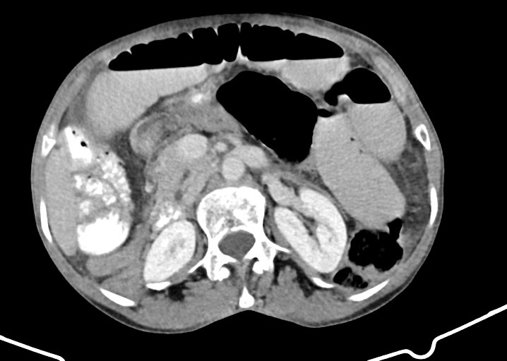 Acute small bowel (ileal) volvulus (Radiopaedia 71740-82139 Axial C+ portal venous phase 84).jpg