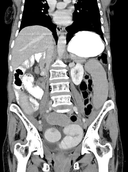 Acute small bowel (ileal) volvulus (Radiopaedia 71740-82139 Coronal C+ portal venous phase 64).jpg