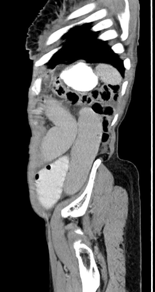 Acute small bowel (ileal) volvulus (Radiopaedia 71740-82139 Sagittal C+ portal venous phase 36).jpg