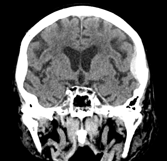 File:Acute traumatic subdural hematoma (Radiopaedia 82921-97257 Coronal non-contrast 43).jpg