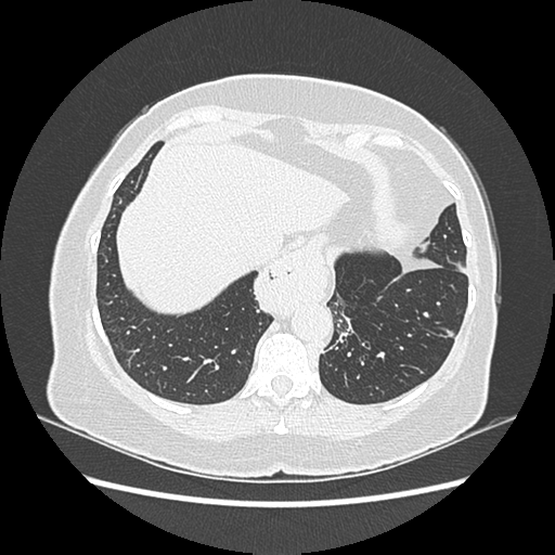 Adenocarcinoma in situ of lung (Radiopaedia 38685-40829 B 181).png