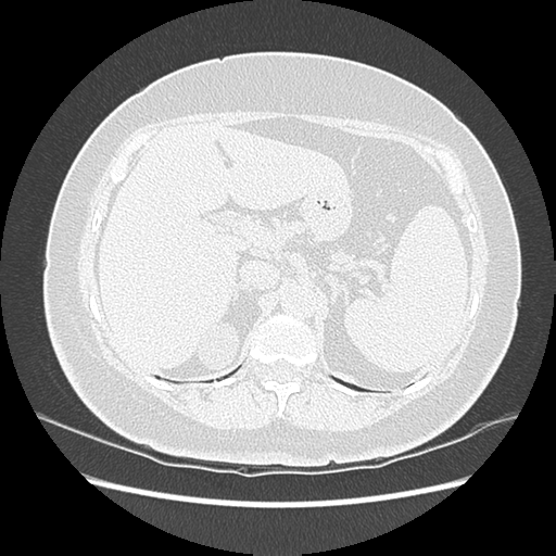 Adenocarcinoma in situ of lung (Radiopaedia 38685-40829 B 219).png