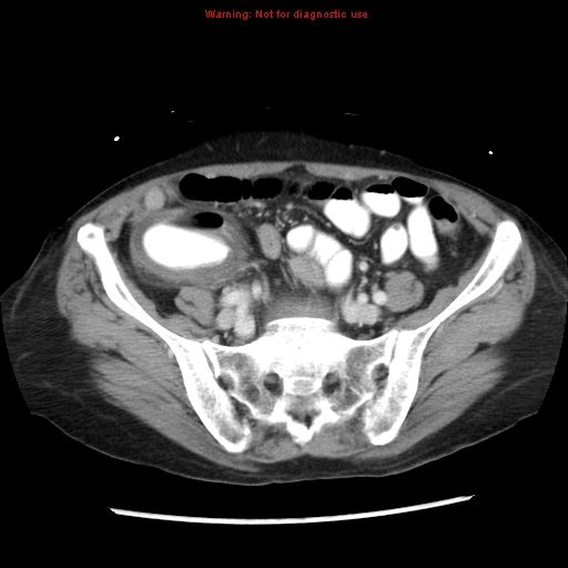 File:Adenocarcinoma of the colon (Radiopaedia 8191-9039 Axial liver window 55).jpg