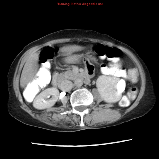 File:Adenocarcinoma of the colon (Radiopaedia 8191-9039 Axial renal excretory phase 19).jpg
