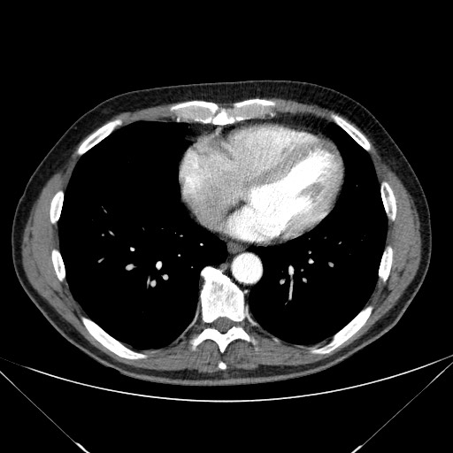 File:Adenocarcinoma of the lung (Radiopaedia 59871-67325 Axial C+ arterial phase 64).jpg