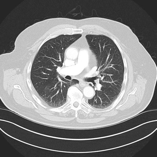 Adenocarcioma of rectum- T1 lesion (Radiopaedia 36921-38547 Axial lung window 27).png