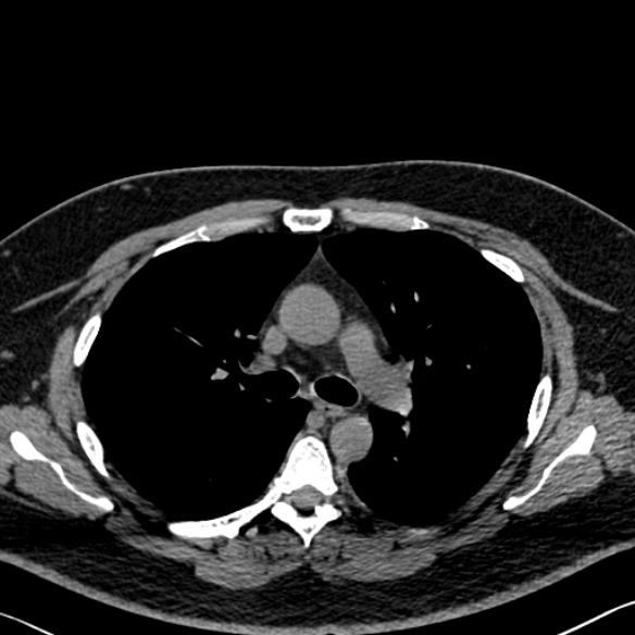 Adenoid cystic carcinoma of the trachea (Radiopaedia 49042-54137 Axial non-contrast 135).jpg