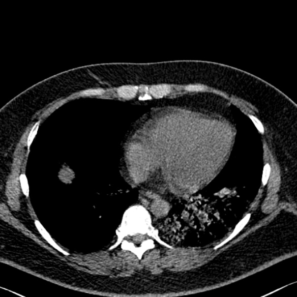 Adenoid cystic carcinoma of the trachea (Radiopaedia 49042-54137 Axial non-contrast 240).jpg