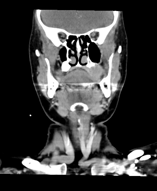 Adenoid cystic tumor of palate (Radiopaedia 46980-51518 Coronal C+ delayed 28).png