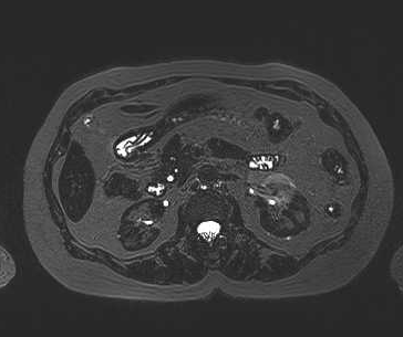 File:Adenomyomatosis of the gallbladder (Radiopaedia 50246-55587 Axial 25).png