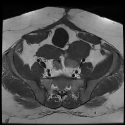 File:Adenomyosis within a didelphys uterus (Radiopaedia 70175-80215 Axial T1 19).jpg