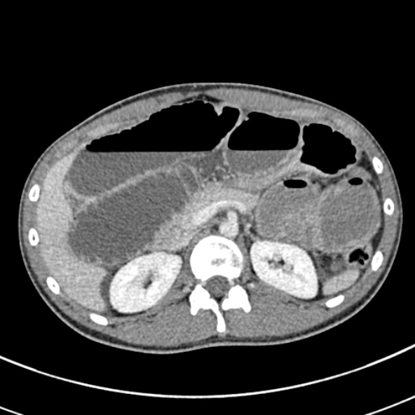 Adhesional small bowel obstruction (Radiopaedia 52107-57980 Axial C+ portal venous phase 36).jpg