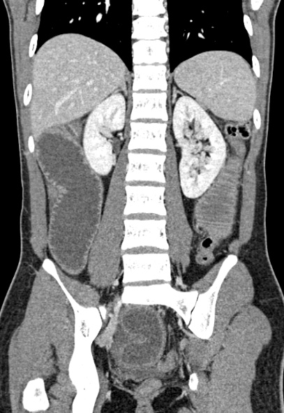 Adhesional small bowel obstruction (Radiopaedia 52107-57980 Coronal C+ portal venous phase 55).jpg