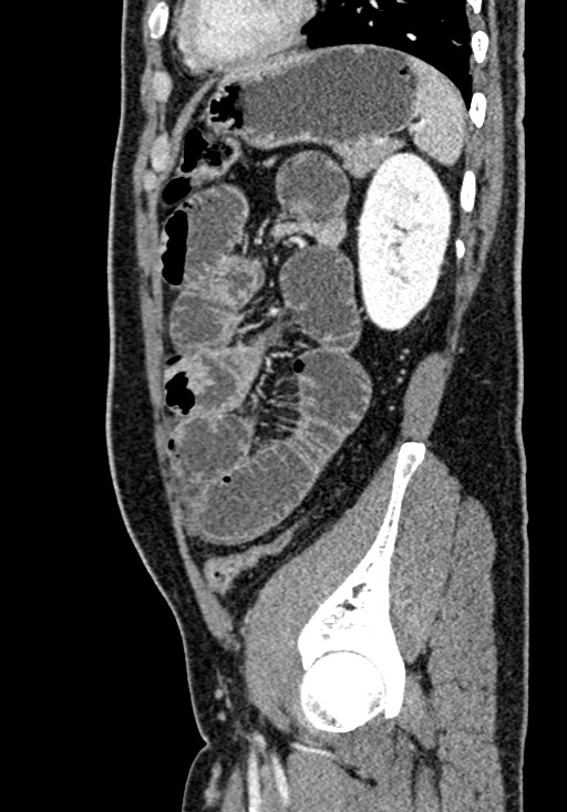 Adhesional small bowel obstruction (Radiopaedia 58900-66131 Sagittal C+ portal venous phase 189).jpg