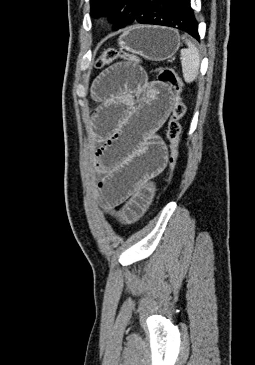 Adhesional small bowel obstruction (Radiopaedia 58900-66131 Sagittal C+ portal venous phase 213).jpg