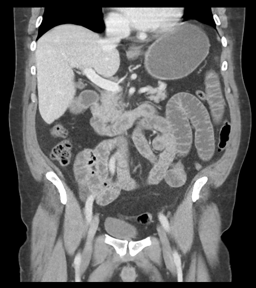 File:Adhesions within abdominal wall hernia (Radiopaedia 58283-65394 Coronal C+ portal venous phase 35).png