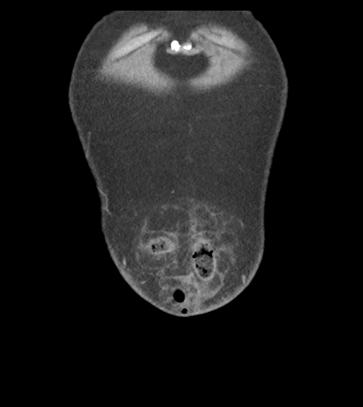 Adhesions within abdominal wall hernia (Radiopaedia 58283-65394 Coronal C+ portal venous phase 8).png