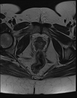 File:Adnexal multilocular cyst (O-RADS US 3- O-RADS MRI 3) (Radiopaedia 87426-103754 Axial T2 22).jpg