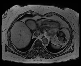 File:Adrenal cortical carcinoma (Radiopaedia 64017-72770 Axial T1 out-of-phase 1).jpg