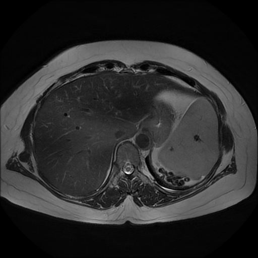 File:Adrenal cortical carcinoma (Radiopaedia 70906-81116 Axial T2 6).jpg