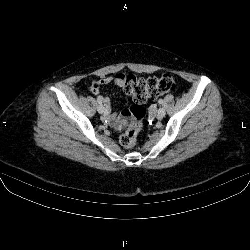 Adrenal cortical carcinoma (Radiopaedia 84882-100379 Axial C+ delayed 80).jpg