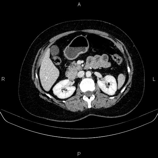 Adrenal cortical carcinoma (Radiopaedia 84882-100379 Axial C+ portal venous phase 35).jpg