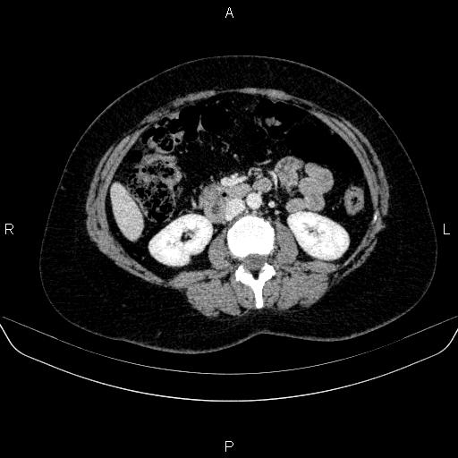 Adrenal cortical carcinoma (Radiopaedia 84882-100379 Axial C+ portal venous phase 43).jpg